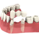 Home 15 Dental Crowns and Bridges at Sigma Dental Clinic Chicago
